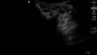Ultrasound guided lumber transforaminal injection.