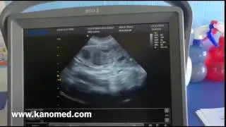 Ultrasound Chison ECO 2 by Kanomed.com