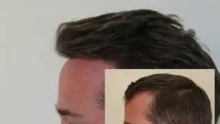 Hair Transplant Turkey, Dense Packing Hairline, Hairline Clinic