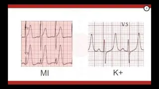 Emergency Management of Hyperkalemia (Part 1)