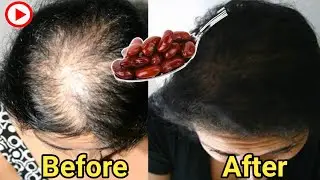 How To Use Beans To Grow Hair 2cm Per Day Very Fast | Hair Growth Pack