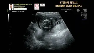 Hydrops Fetalis Hygroma Cystic