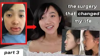 DOUBLE JAW SURGERY changed my life | Before & After | i hated myself (PART 3)