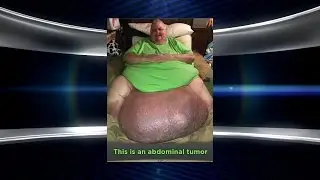 Exclusive: The Story behind Man&rsquo;s 130-Pound Abdominal Tumor