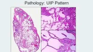UIP (Track H Stop 7) IPF: Navigating a Complex Disease