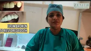 Do you have a broken front tooth. Avoid implant