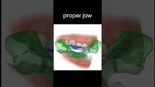 Correcting Class II div 1 malocclusion with Twin Block #braces #teeth #dentist #treatment