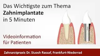 Implantat Zahnarzt Frankfurt-Niederrad Dr. Siuosh Rassaf