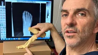 Fit Foot U w/ Dr. Pearl:Sesamoid Stress Reaction in Foot