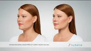 Kybella Commercial