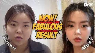 [Plastic Surgery Review] Mini Facelift, Double Chin Removal Review | V.LIF Plastic Surgery Korea
