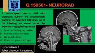 Hypothalamic hamartoma - Radsynapse