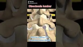 Disectomia lumbar, as&iacute; operamos