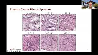 AIMI Grand Rounds: The Opportunity for AI to Improve Prostate Cancer Detection and Treatment