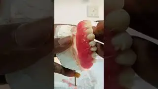 How to wax up an upper denture&hellip;. #Part 2