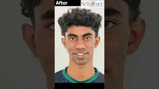 Jaw Alignment Transformation | Patient Progress