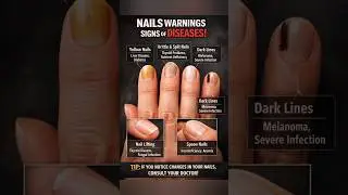 Nails are giving alarm signals! SIGNS of diseases by nails