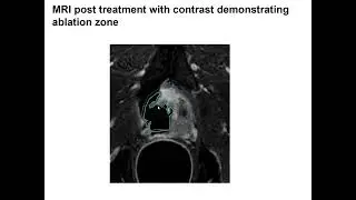 Behfar Ehdaie: MRgFUS Focal Therapy for Patients with Intermediate-Risk Prostate Cancer