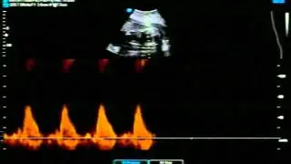 Parker's Ultrasound at 25 weeks (2D-3D)