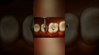 Shape anatomy, achieve perfection &mdash; with the Occlusal Shaper Bur #dentalart