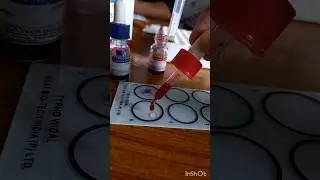 WIDAL TEST PROCEDURE FOR TYPHOID