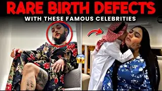 7 Hollywood Icons Born with Rare Birth Anomalies |