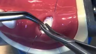 Ridge preservation+Double Layered Open Membrane Technique DL OMT + Hidden X