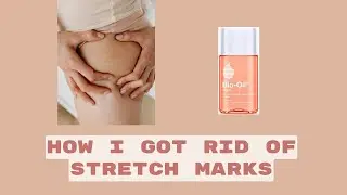 HOW I GOT RID OF STRETCH MARKS!!  Bio Oil Skincare Oil Review! Transform Your Skin!
