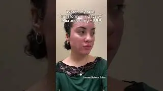 Watch My Skin Transform After Microneedling + PRP