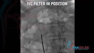 Placement of IVC filter