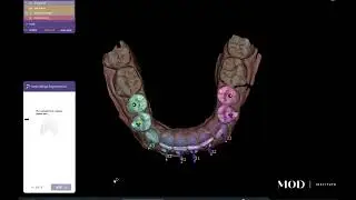 exocad detachable  dies for veneer cases in under 5 minutes
