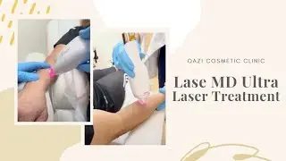LaseMD Ultra Laser Treatment on Hands & Forearms | Live with Dr. Nadir Qazi