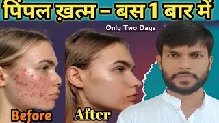 Pimples Removal On Face At Home। मुंहासे हटाने के उपाय । Scars&Dark Spots से छुटकारा । गोरा और साफ।