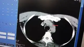 How to do ct brain neck angio