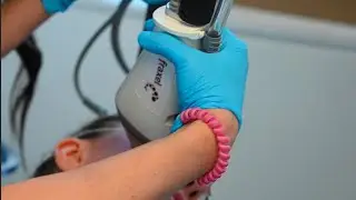 Fraxel Laser Downtime and Results
