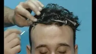 Applicazione Protesi in Lace