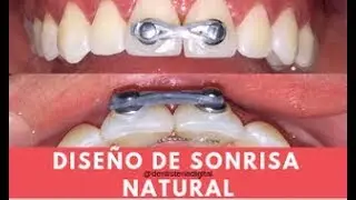 Diseño de Sonrisa - Procedimientos después de la Ortodoncia
