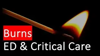 BURNS, Overview from A&E to Critical Care, Classification, Pathophysiology, Management , Prognosis