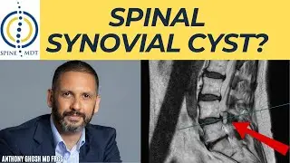 What Is a Synovial Cyst of the Spine? - Spine Surgeon Explains