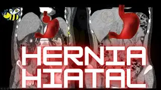 ⚠️▶️HERNIA HIATAL ⚠️▶️✔️