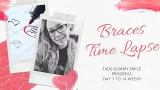 Time lapse with TADs// Gummy smile correction