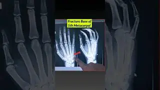 Fracture 5th Metacarpal Bone⚡️ X-ray Hand #xray #fracture #bones