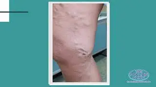 Trattamento delle varici con microscleroterapia e flebectomia