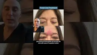 Frown Line Treatment