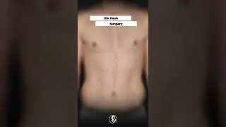 Sixpack Surgery #shorts