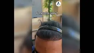 ADVANCED HAIR TRANSPLANT SPECIALIST | 6 MONTHS RESULT