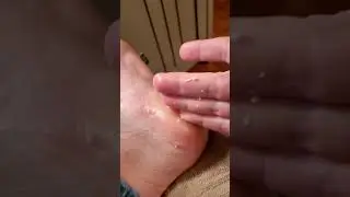 Drops of Youth Liquid Peel on Feet! SATISFYING