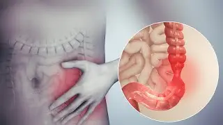 Inflammatory Bowel Disease GI