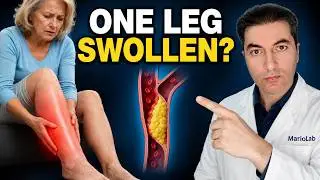 5 Warning Signs Your Leg Arteries Are Clogged (Don't Ignore This!)
