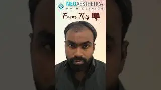 Transformed from thinning to thriving! Witness the remarkable results of our patient #hairtransplant